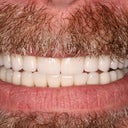 Full Mouth Reconstruction