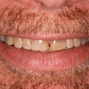 Full Mouth Reconstruction