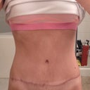 22 weeks, still wish scar would fade quicker
