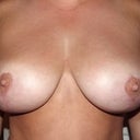 close up of breast scars & how well they have faded already
