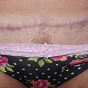 close up of tummy scar & you can see how much the right droops compared to the left. I have to lift skin to apply scar treatment...not happy about that :(