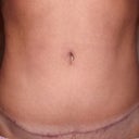 you can see the definition in my abs but you can also see the drooping tummy scar & lopsided navel scar as well as how the navel scar is around the navel & not tucked inside as I was told it would be :/