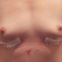Day 4 after explant. The blister in the middle below my breasts is from the surgical tape being a bit too tight. Other than that little hick-up, I am over the moon,