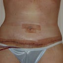 5 Days Post Op