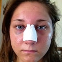 My cheeks are really swollen; Day 3