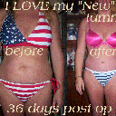 36 days post op ~ before & after ~ LOVE IT!
