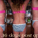 36 days post op ~ LOVE IT!