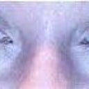Ten days after the Botox which gave me NEW wrinkles under my eyes that were not there at all before.....