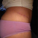 scar at 5 months post op