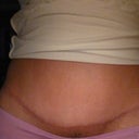 My happy face again at 5 months post op