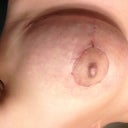 Day 19 left breast