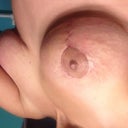 Day 19 right breast