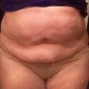 Pre tt after lipo