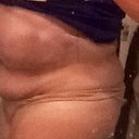 Pre tt after lipo side