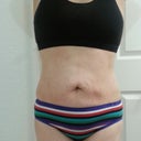 The front view 6 weeks post op. I know it will look so much better after the tt.