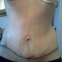 Post Op 8 days. HOLY SCAR! It'll get better though with time. But you can tell there's NO SKIN FLAP!! HOORAY!
