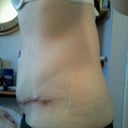 side view- Post Op 8 days