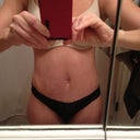 3 weeks post op...still swollen near incision, but getting better!