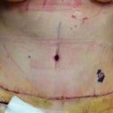 Post op Day 5. Picture taken while laying flat on exam chair at PS office. Picture was taken immediately after bandage and garment removal.