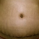 Day 9 PO. Close up of my belly button. Still has some dried blood/scabs in there to be cleaned up. Won't have a good idea of end result for a couple more weeks. Already looks better than what I had!