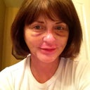 day 13 without make-up you can see the bruising