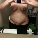 5 Days post op, hips have evened out. Breasts look different sizes but doc says it's due to swelling and not to worry.