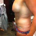 day after surgery