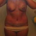 day 10 post op