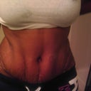 This is my wrinkly tummy.  It's still really flat even with all the swelling.  It was more wrinkle than this.  My doctor said this is a result of making the incision so small and the waist contouring that I got.  My waist is pretty small.  I love it.