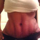 Just a closer pic of my tummy.  Incision is not as flat as I would like but I have not started any scar therapy yet.  Waiting for the left side to heal all the way.  Again, happy with result and I can wear a wide beater.  Yippy!!