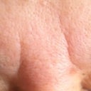 after 30 units of botox, not helping the horrible 11's