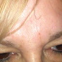 3 days after juvederm treatment
