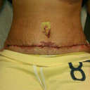 24 hours post op
