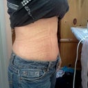 8 weeks post op side view
