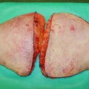5 pounds of skin removed