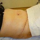 1 week post op - swollen