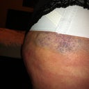 Hip has a bit of bruising