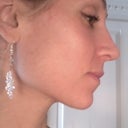 5 weeks post op and swelling has really gone down
