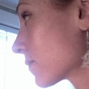 left profile 5 weeks post op...this angle used to be my worst and now I love it!