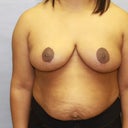 Breast Reduction And Breast Lift Following Child Birth And Breast Feeding