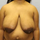 Breast Reduction And Breast Lift Following Child Birth And Breast Feeding