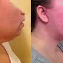 Here is a before/after comparison. After is SIX weeks post op.