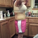 8 Days Post Op evening, note the massive swelling that built up during the day....don't be discouraged if you are checking yourself out at night!