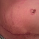 4-7-11 scar in front