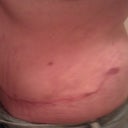 4-7-11 sideview of scar