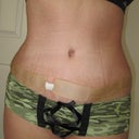 Front view, actually looks better in person.  None-the-less much better than pre-surgery!