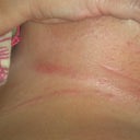 burning rash after 7 hours wearing clothes!