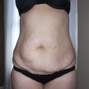 Before the sugery