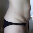 side view before the surgery