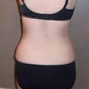 Back view before surgery.